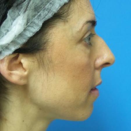 Before image 3 Case #86856 - 40 year old woman treated with Nose Surgery/Septoplasty/Turbinectomy