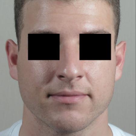 Before image 1 Case #103126 - Rhinoplasty Patient 75