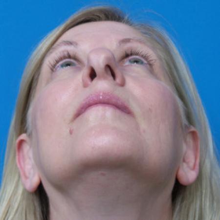 Before image 4 Case #102241 - 56 year old  -  Open Rhinoplasty/Septoplasty/Turbinectomy  -  5 months post-op