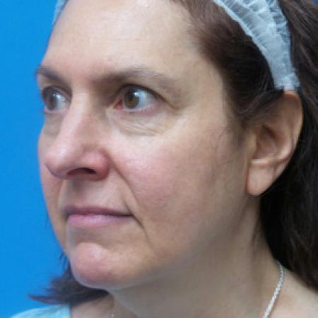 Before image 2 Case #102181 - 58 year old  -  Browlift/Facelift/Lower Blepharoplasty/TCA Peel  -  10 months post-op
