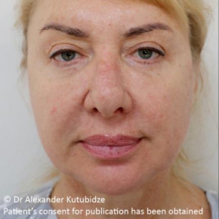 Before image 1 Case #103361 - Deep Plane Face Lifting