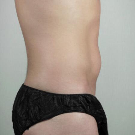 Before image 2 Case #103131 - Liposuction of the Abdomen & Flanks Patient 70