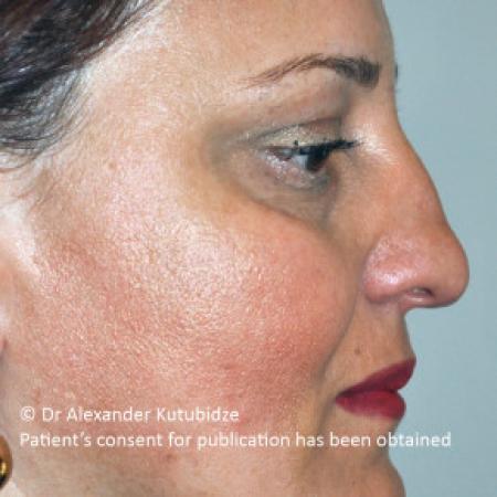 Before image 5 Case #103366 - 8 years after aging aesthetic functional rhinoplasty secondary to previous teen age septoplasty 