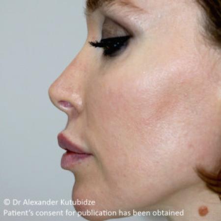 Before image 4 Case #103351 - Revision Rhinoplasty. 3 years after