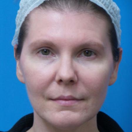 Before image 1 Case #102231 - 39 year old  -  Endoscopic Browlift    5 months post-op