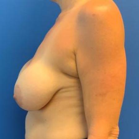Before image 3 Case #103336 - Removal of Implants with Fat Grafting to Breasts for a 50 year old female