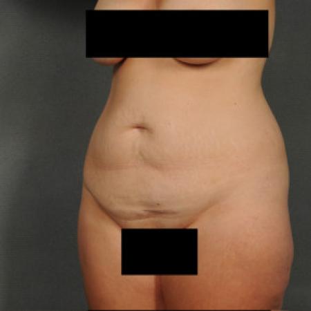 Before image 2 Case #101591 - Abdominoplasty