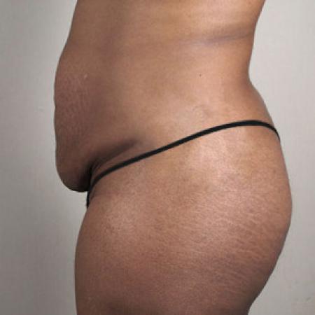 Before image 2 Case #103171 - Tummy Tuck with Liposuction Patient 57