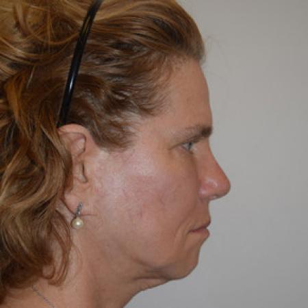 Before image 3 Case #101576 - Facelift
