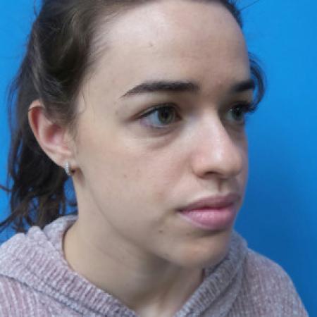 Before image 2 Case #102236 - 22 year old  -  Open Rhinoplasty  -  3 months post-op
