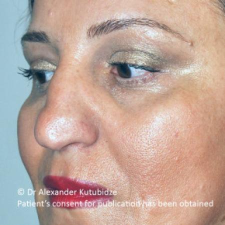 Before image 3 Case #103366 - 8 years after aging aesthetic functional rhinoplasty secondary to previous teen age septoplasty 