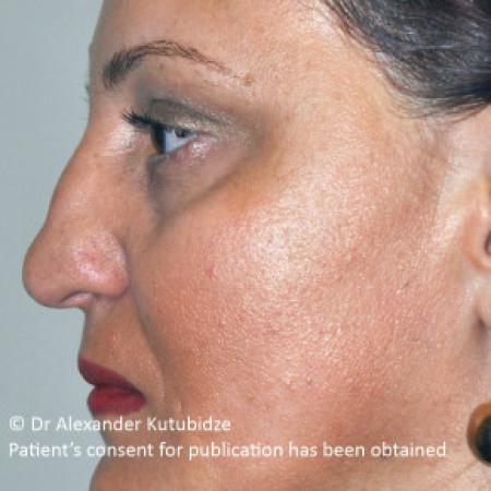 Before image 4 Case #103366 - 8 years after aging aesthetic functional rhinoplasty secondary to previous teen age septoplasty 