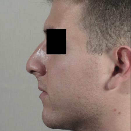 Before image 2 Case #103126 - Rhinoplasty Patient 75