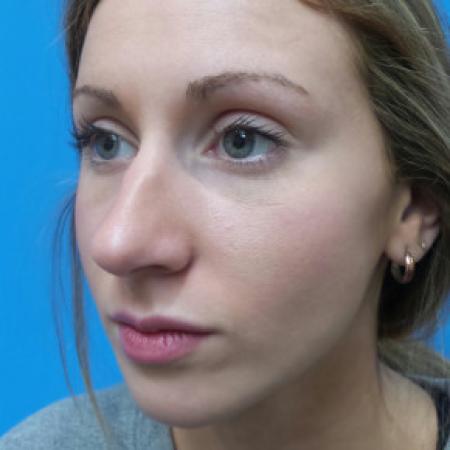 Before image 2 Case #102171 - 18 year old - Open Rhinoplasty w/submucous resection/Septoplasty & Spreader grafts to improve airway 