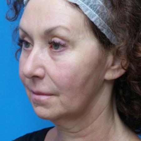 Before image 2 Case #102266 - 55 year old  -  Facelift  -  2 months post-op