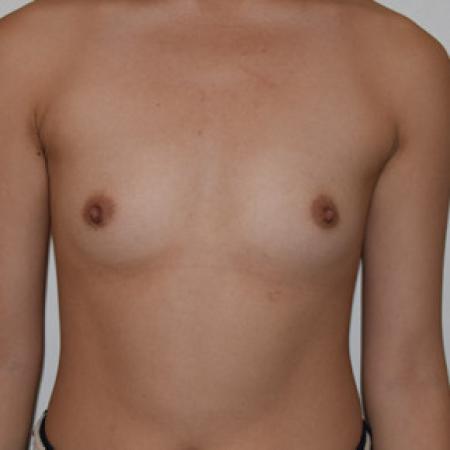 Before image 1 Case #101581 - Breast Augmentation