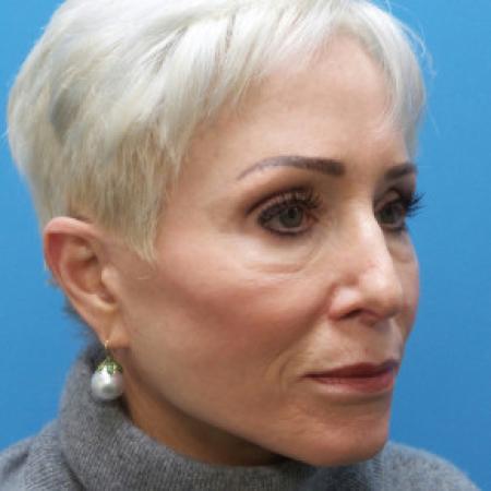 Before image 2 Case #102246 - 65 year old  -  Open Secondary Rhinoplasty. Revision from another surgeon    1 month post-op