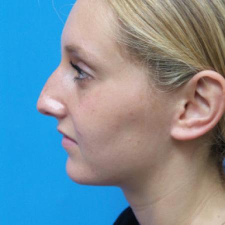 Before image 3 Case #102301 - 17 year old  -  Open Septo-Rhinoplasty  -  3 months post-op