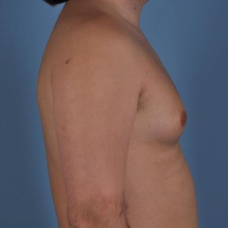 Before image 3 Case #103221 - Male Breast Reduction