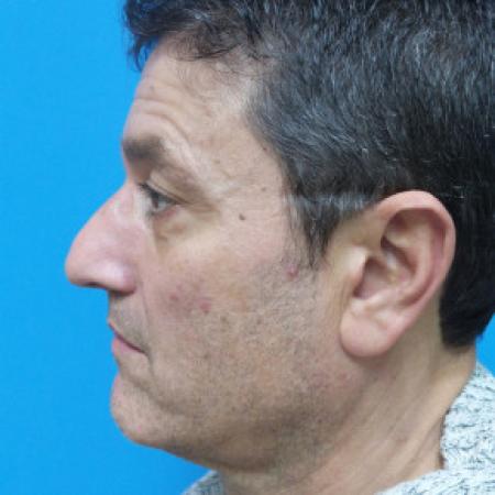 Before image 3 Case #102161 - 54 year-old  -  Rhinoplasty/Septoplasty/Turbinectomy   4 weeks post-op