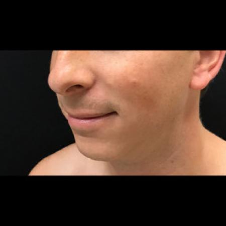 Before image 2 Case #101561 - CHIN IMPLANT