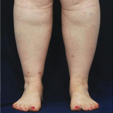 Before image 1 Case #102686 - Lower Leg Liposuction