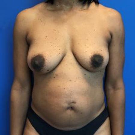 Before image 1 Case #103306 - Mastopexy with autologous fat grafting to breasts and aAbdominoplasty for a 45 year old female