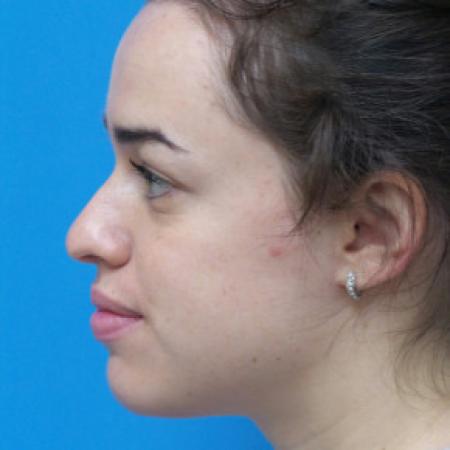 Before image 3 Case #102236 - 22 year old  -  Open Rhinoplasty  -  3 months post-op