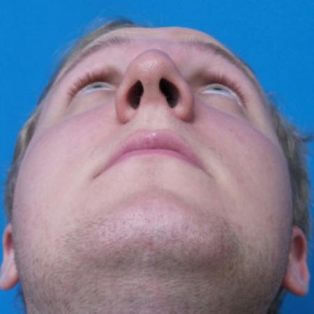 Before image 4 Case #102296 - 19 year old  -  Open Septo-Rhinoplasty with Inferior Turbinectomies  -  3 months post-op