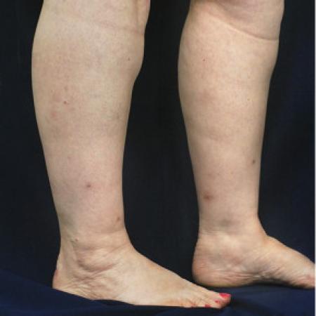 Before image 2 Case #102686 - Lower Leg Liposuction