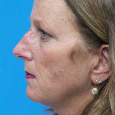 Before image 3 Case #102276 - 55 year old - This patient presented with exposed bone after sustaining an open nasal bone fracture.