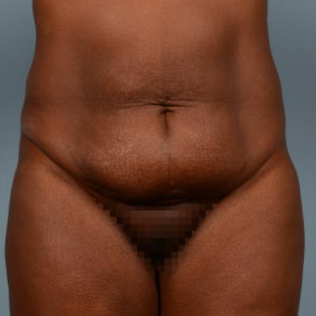 Before image 1 Case #103226 - Tummy tuck with liposuction of hiprolls