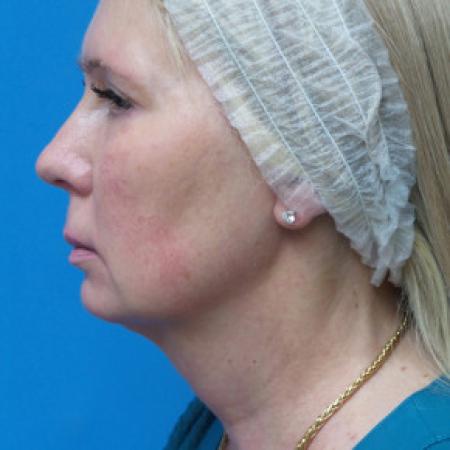 Before image 3 Case #102321 - 60 year old  -  Necklift & Facelift  -  3 months post-op