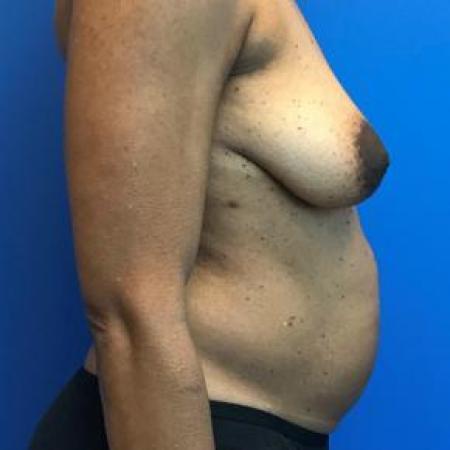 Before image 3 Case #103306 - Mastopexy with autologous fat grafting to breasts and aAbdominoplasty for a 45 year old female