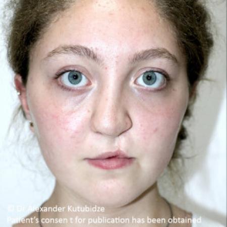 Before image 1 Case #103356 - One year after repair of the unilateral cleft lip/nose deformity
