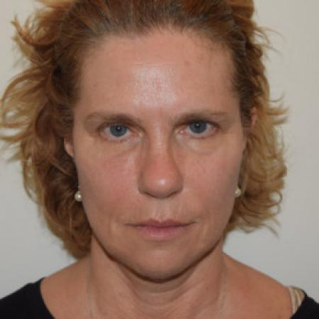 Before image 1 Case #101576 - Facelift