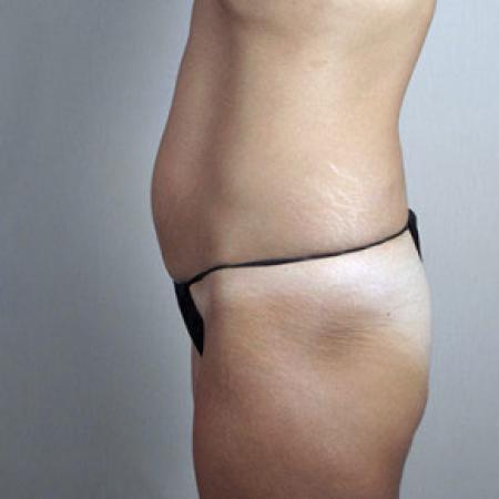 Before image 2 Case #103166 - Mini Tummy Tuck Patient 20