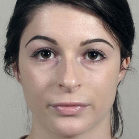 Before image 1 Case #103141 - Rhinoplasty Patient 72