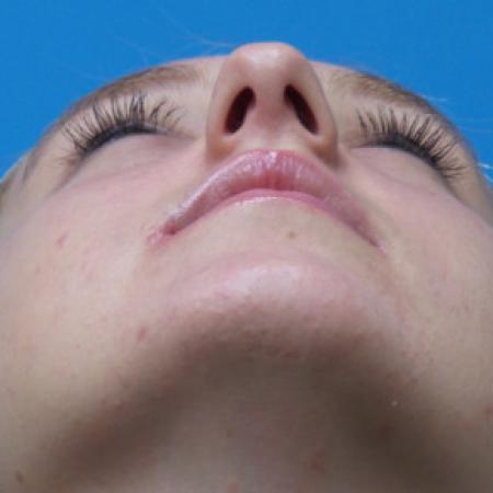 Before image 4 Case #102301 - 17 year old  -  Open Septo-Rhinoplasty  -  3 months post-op