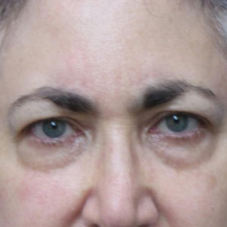 Before image 1 Case #102221 - 66 year old   -  Upper Blepharoplasty/Facelift  -  3 1/2 months post-op
