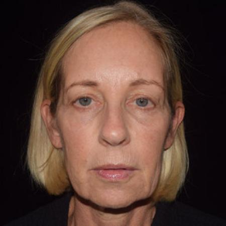 Before image 1 Case #101566 - Blepharoplasty