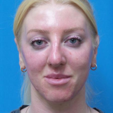 Before image 1 Case #102326 - 29 year old  -  Open Rhinoplasty  -  3 months post-op