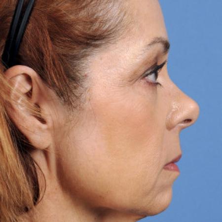Before image 3 Case #102136 - Facelift - 60-year-old woman