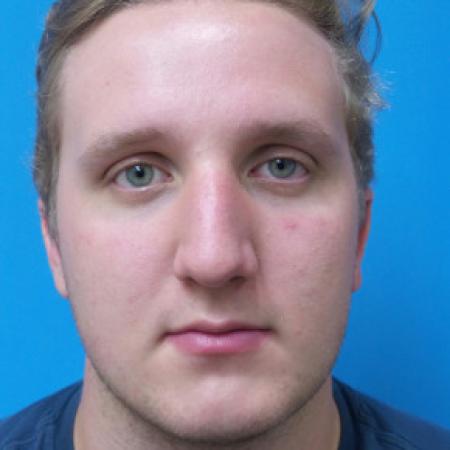 Before image 1 Case #102296 - 19 year old  -  Open Septo-Rhinoplasty with Inferior Turbinectomies  -  3 months post-op