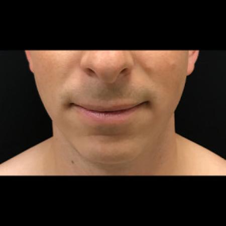 Before image 3 Case #101561 - CHIN IMPLANT