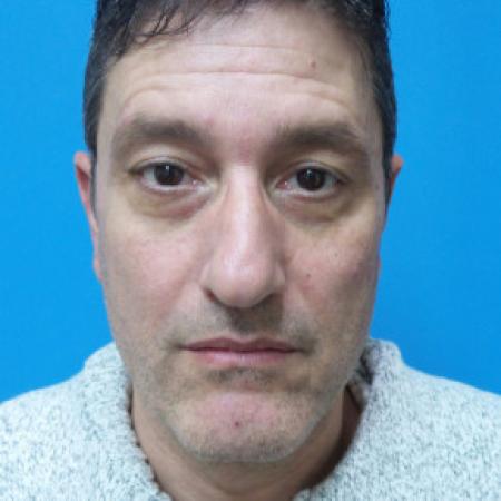 Before image 1 Case #102161 - 54 year-old  -  Rhinoplasty/Septoplasty/Turbinectomy   4 weeks post-op