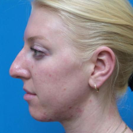 Before image 3 Case #102326 - 29 year old  -  Open Rhinoplasty  -  3 months post-op