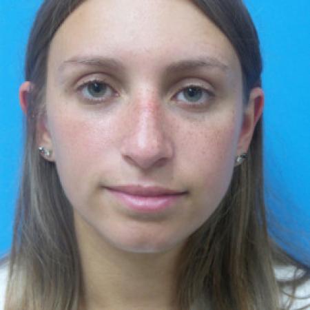 Before image 1 Case #102191 - 22 year old  -  Rhinoplasty/Septoplasty/Turbinectomy  -  1 month post-op