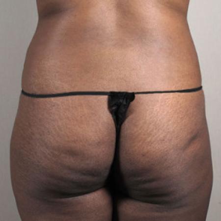 Before image 3 Case #103171 - Tummy Tuck with Liposuction Patient 57