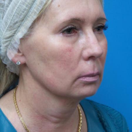 Before image 2 Case #102321 - 60 year old  -  Necklift & Facelift  -  3 months post-op